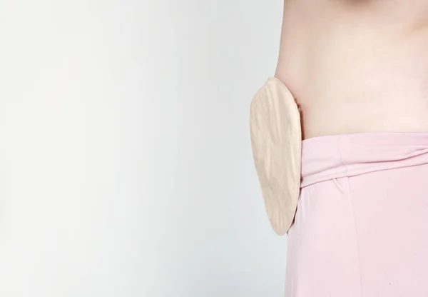 Vista de la bolsa de colostomía adjunta a la mujer paciente primer plano, tema médico. Tratamiento quirúrgico del cáncer de colon . — Foto de Stock