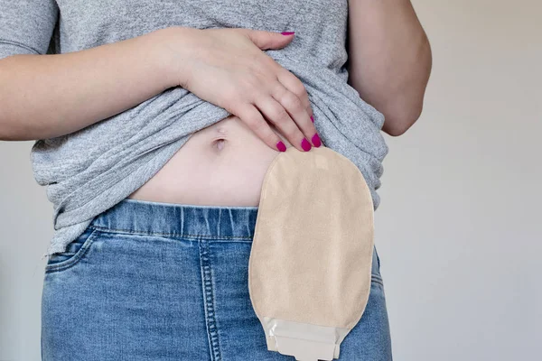 Vista frontal de la bolsa de colostomía en color de piel adherida al paciente —  Fotos de Stock