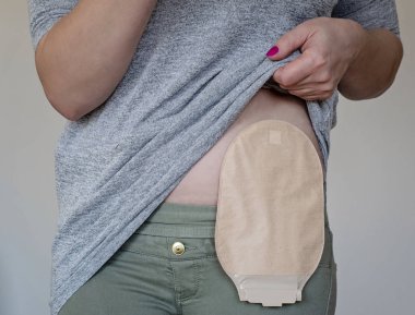 Front view on colostomy pouch in skin color attached to woman clipart