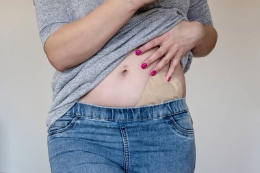 Front view on colostomy pouch in skin color attached to woman clipart
