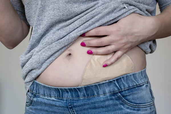 Vista frontal na bolsa de colostomia na cor da pele anexada à mulher — Fotografia de Stock