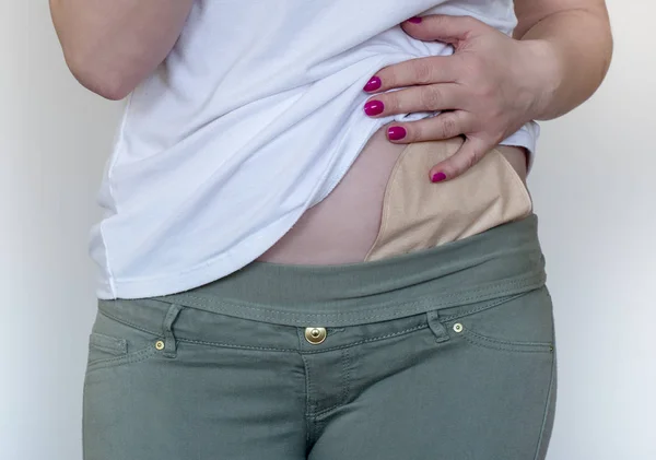 Vista frontal de la bolsa de colostomía en color de piel unida a la mujer —  Fotos de Stock