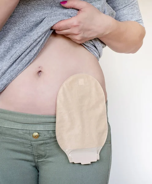 Vista frontal de la bolsa de colostomía en color de piel unida a la mujer —  Fotos de Stock