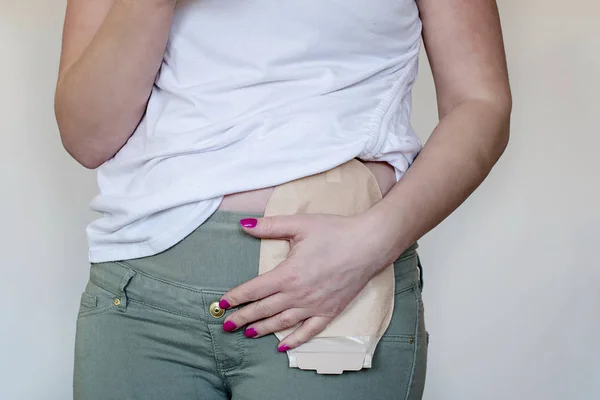 Vista frontal de la bolsa de colostomía en color de piel unida a la mujer — Foto de Stock