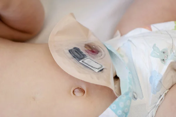 Nahaufnahme von oben auf transparentem Colostoma-Beutel, der am Baby befestigt ist — Stockfoto