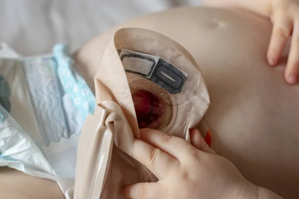 Close-up top view on transparent colostomy pouch attached to baby — Stock Photo, Image