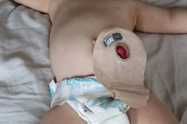 Vista superior de cerca de la bolsa de colostomía transparente unida al bebé — Foto de Stock