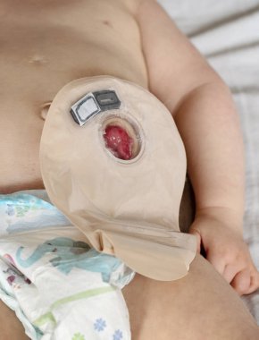 Close-up top view on transparent colostomy pouch attached to baby clipart