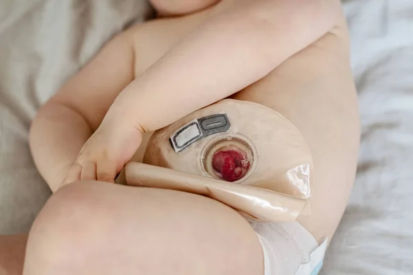 Close-up bovenaanzicht op transparante colostomiezakje bevestigd aan baby — Stockfoto