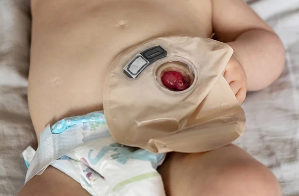 Close-up bovenaanzicht op transparante colostomiezakje bevestigd aan baby — Stockfoto