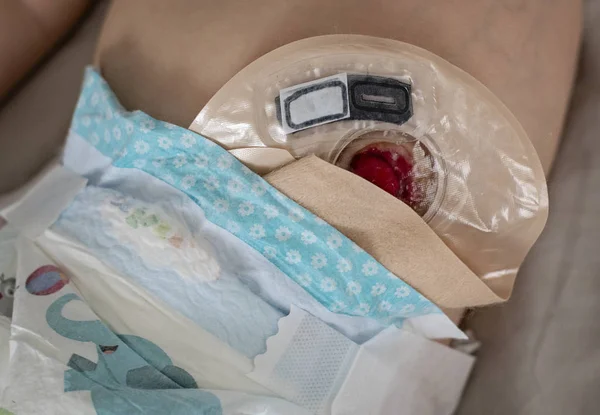 Vista superior de cerca de la bolsa de colostomía transparente unida al bebé — Foto de Stock