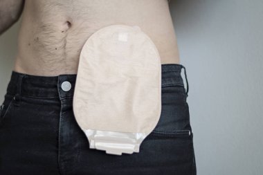 Front view on colostomy bag attached to man patient clipart