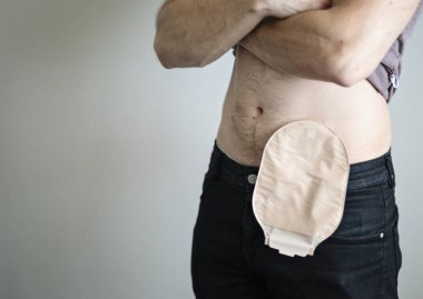 Front view on colostomy bag attached to man patient clipart