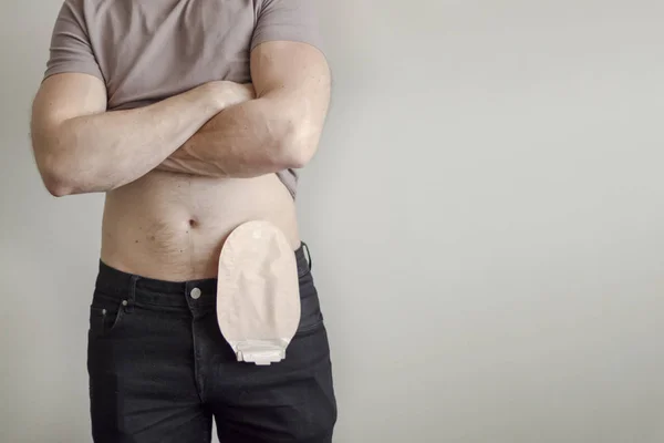 Front view on colostomy bag attached to man patient — Stock Photo, Image