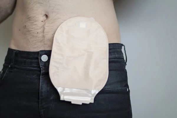 男病人结肠造口术袋的前景 — 图库照片