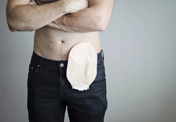 Front view on colostomy bag attached to man patient