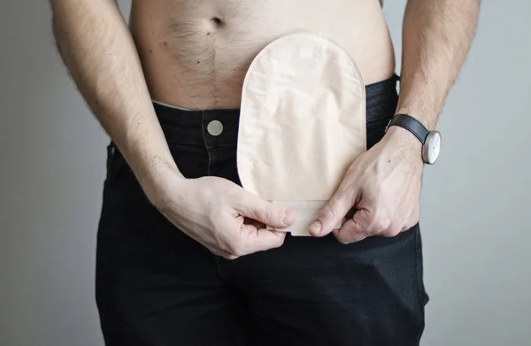 Vue Face Sur Sac Colostomie Attaché Homme Patient Thème Médical — Photo