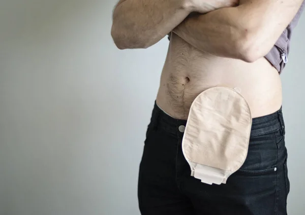 Vista frontal de la bolsa de colostomía unida al paciente hombre — Foto de Stock