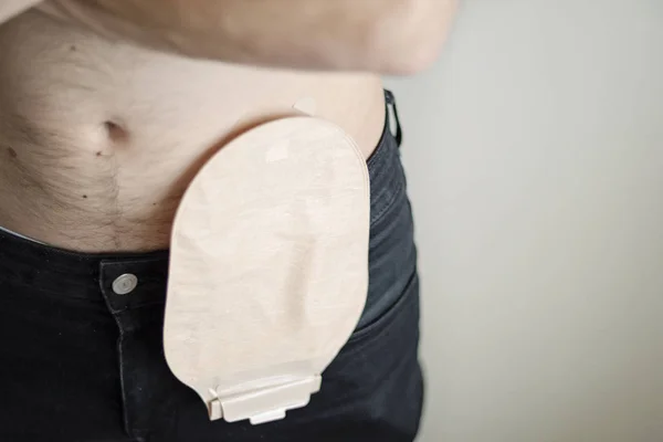男病人结肠造口术袋的前景 — 图库照片