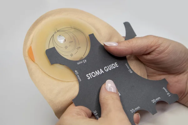 Kolostomi ameliyatından sonra kolostomi torbasının üst görüntüsü, kolon kanseri tedavisi. Deri rengi filtreli ostomi torbası. Tıbbi tema. Stoma bag ve stoma guide in women hands.