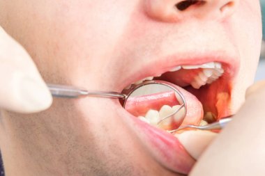 Profesyonel bir enstrümanın yardımı ile ağız boşluğu muayene.