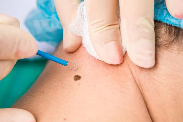 Ärztliche Behandlung Entfernung des Maulwurfs am Hals des Patienten. — Stockfoto