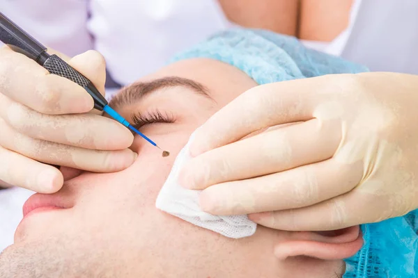 Eliminación de la marca de nacimiento de la cara del paciente . — Foto de Stock