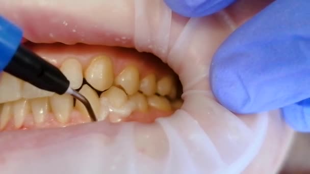 Liquid cofferdam, photopolymer, is applied to teeth during whitening — Stock Video