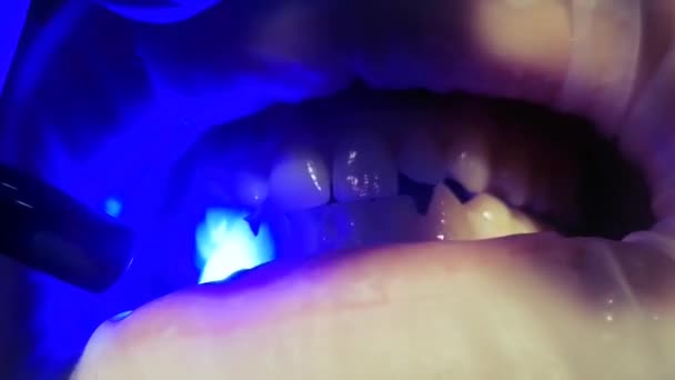 Barragem de borracha líquida é exposta nos dentes para clareamento — Vídeo de Stock