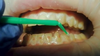 Alt dişlerde, beyazlatıcı jel bir fırçayla sürülür..