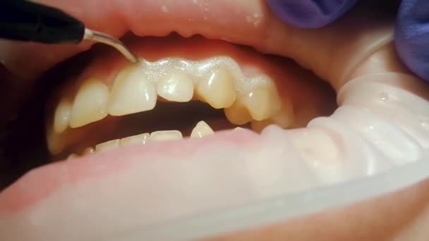 On incisors, liquid rubber dam, composite, photopolymer for bleaching is applied — Stock Video