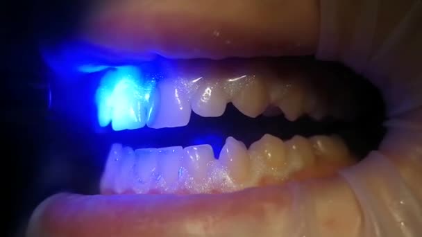 Üst dişlerin ortasında ultraviyole lambayla parlıyorlar. — Stok video