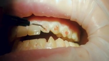 Diş beyazlatma jeli dişlerin üst sırasına uygulanır.
