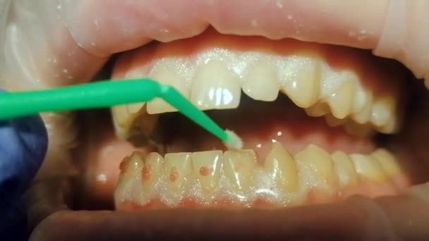 Żel wybielający jest rozprowadzany szczotką po wszystkich dolnych zębach — Wideo stockowe