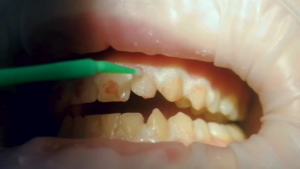 Op de bovenste rij tanden besmeurd rood whitening materiaal in de mondholte. — Stockvideo