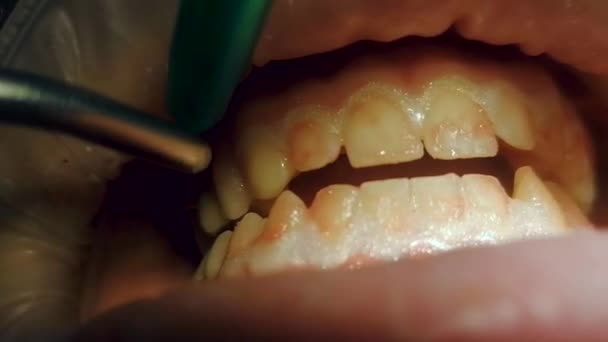 Red whitening gel is washed off with upper teeth — Stock Video