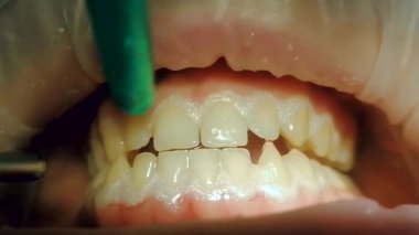 Havuz temizleyicisi dişlerdeki beyazlatıcı jeli temizler ve salya salyasını soğutur.