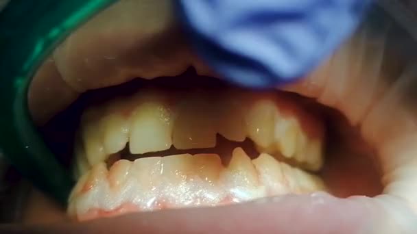 Un eyector de saliva recoge agua de una boquilla en la cavidad oral — Vídeo de stock