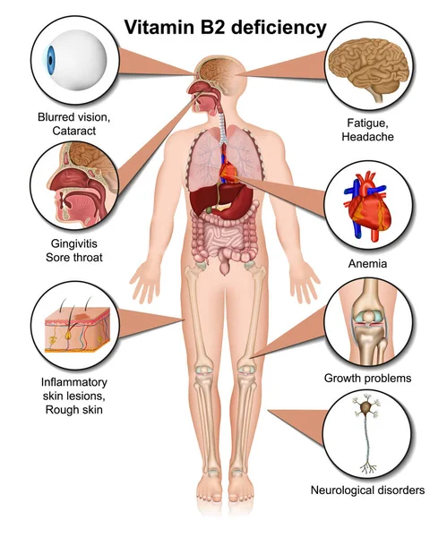 Infografía Deficiencia Vitamina Ilustración Vectores Médicos Sobre Fondo Blanco — Vector de stock