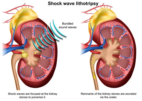 Shock Wave Lithotripsy Medical Vector Illustration White Background — 스톡 벡터