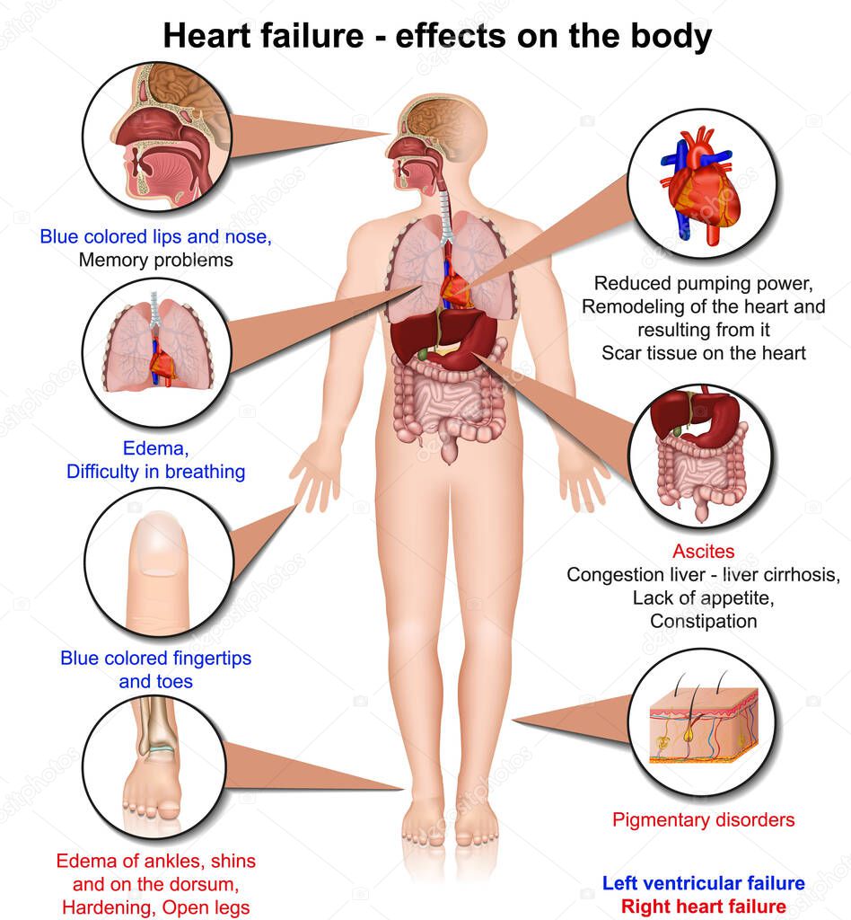Hearth failure effects of the body 3d medical vector illustration on white background, infographic