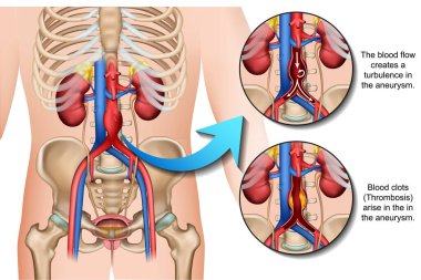 Abdominal anevrizma. Beyaz arkaplanda izole edilmiş 3d tıbbi vektör illüstrasyonu. 10 eğitim vektörü.