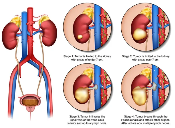 腎臓がん3D医療ベクトル図と説明分離白背景と尿路系Eps — ストックベクタ