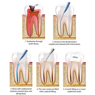 kök kanal tedavisi tıbbi vektör çizimi beyaz arka plan diş bilgisinde izole edildi