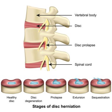 Disk fıtık omurgası ve disk anatomisi 3D tıbbi vektör illüstrasyonunun aşamaları 10 puan.