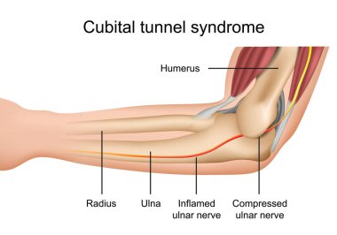 Kübital tünel sendromu. İngilizce tanımlı tıbbi vektör çizimi.