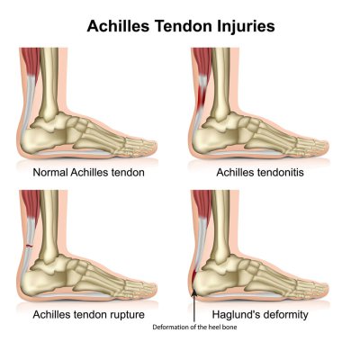 Achilles tendon injures medical vector illustration isolated on white background with english description eps 10 infographic clipart