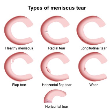 types of meniscus injuries medical vector illustration clipart