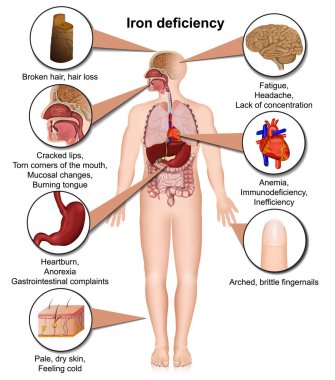 Beyaz arkaplanda izole edilmiş 3 boyutlu tıbbi vektör illüstrasyonunda demir eksikliği etkileri 10 bilgi verir