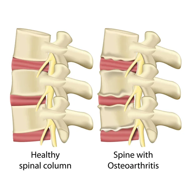 Columna Vertebral Con Osteoartritis Columna Vertebral Vector Médico Ilustración Aislada — Archivo Imágenes Vectoriales